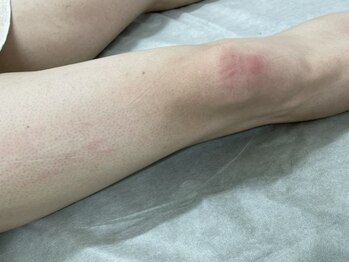 ナノハナ/鹿沼市全身脱毛美容室ナノハナ