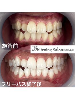 ホワイトニングサロン 京都烏丸店/ホワイトニング施術例