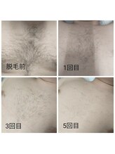 サロン ピューパ(Salon pupa)/男性胸脱毛　before→after