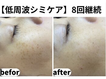 ティエル 高崎店(Tiele)/【雀卵斑みたいだったのに】