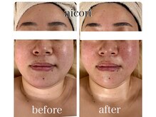 ニコリ(nicori)の雰囲気（◆小顔矯正で頬骨の位置が上がりシャープなフェイスラインへ）