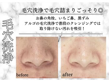 アルゴ 柳川店(ALGO)/大人気♪毛穴ごっそり大洗浄！