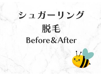 ヒーリングハーツ(Healing Hearts)/シュガーリング脱毛のB&A