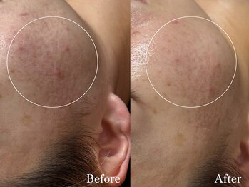 ラティエ(Latier)/ハーブ1回目のお肌の変化☆