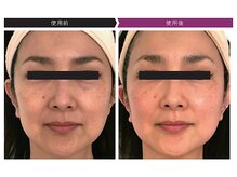 パーフェクトフェイスビューティー 梅田店(PERFECT FACE BEAUTY)/ディレイアコスメ（1種）使用