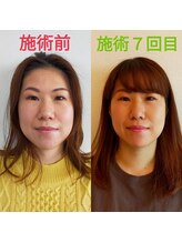 シャルム(Charme)/小顔矯正施術７回後