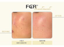 ハーバル 新宿店(HERBAL)/最強★韓国FCRハーブピーリング