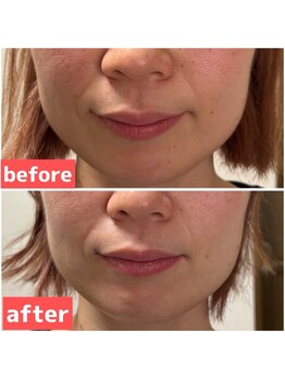 エリシオン(ELYSION)/最新機種RFリフトアップ