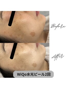 プレジール 大野城店(plaisir)/WiQo水光ピール