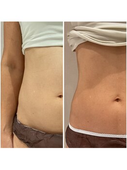 ピエルポゼ(Piereposer)の写真/本気で美しくなりたい方必見☆最新マシンパーフェクトマスターとハンドの合わせ技で驚きの変化を実感♪