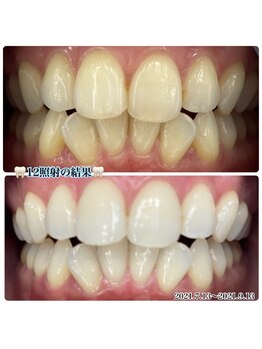 ラブホワイトニング 渋谷店(LOVEホワイトニング)/12回照射ホワイトニング