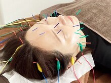 希実鍼灸院(nozomi)/スッキリ/リフトアップ美容鍼