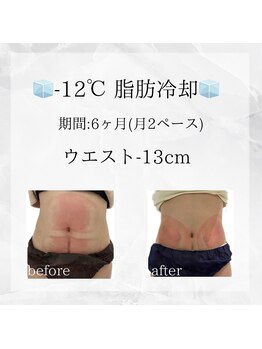メディカルエステ 東銀座店/-12℃脂肪冷却 before/after