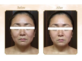 ハンズ鍼灸接骨院小牧院 美容整体ハンズ(美容整体hands)/小顔 before after