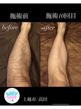 ベイビースキン(Baby skin)/メンズ Before→after