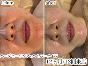 リミー 東大宮店(REME)/【ハーブ】シワ緩和・艶・透明感