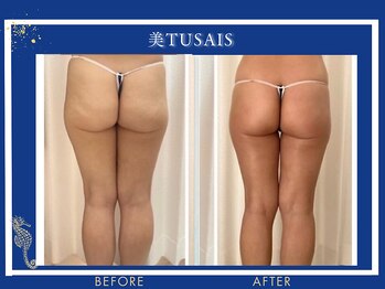 ビテュセスリー はなみずき店(美tusais3)/【美尻・美脚】ヒップアップ