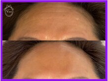 ヴィオール 名古屋栄店(VIOR)/シワ改善・ハリ・弾力UP効果！