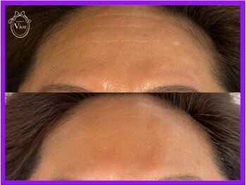 ヴィオール 名古屋栄店(VIOR)/シワ改善・ハリ・弾力UP効果!