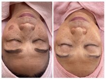 美キュート/シミケアコンテスト全国2位受賞