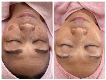 美キュート/シミケアコンテスト全国2位受賞