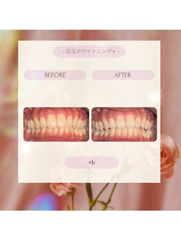 プラスビーセルフ(+b self)/ホワイトニングビフォーアフター