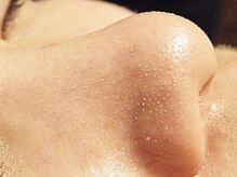 ビュップ 目黒店(美up)/毛穴レス