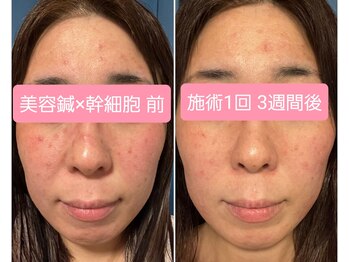 エルアンドエス(L&S)/敏感肌/ニキビ肌ケア