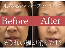カンフリエ 吉野ヶ里店(Camphrier)の雰囲気（40代から気になるほうれい線もお任せ！※１回　ハーブピーリング）