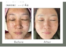 サロン バイオビオ(SALON BioBio)/シケア集中コース