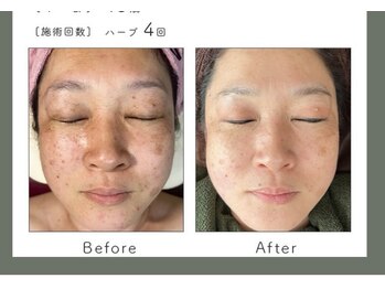 サロン バイオビオ(SALON BioBio)/シケア集中コース