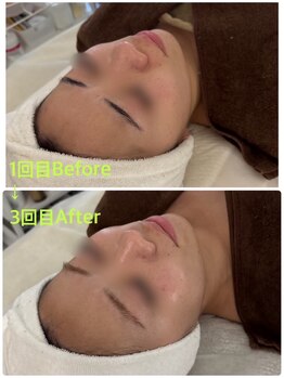 ラルゴ(Largo)/赤み、くすみを一掃♪