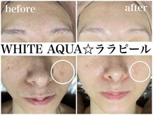 ホワイトアクア 福岡天神店(WHITE AQUA)/ララピールでシミ、美白ケアを