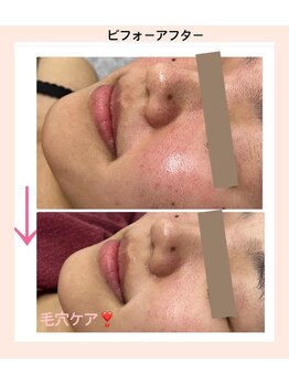 リファイン(REFINE)/毛穴汚れやザラつきも改善！