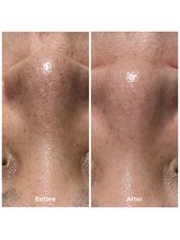 ゆりの花/毛穴洗浄