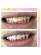 エクシアホワイトニング 天王寺店/ホワイトニングビフォーアフター