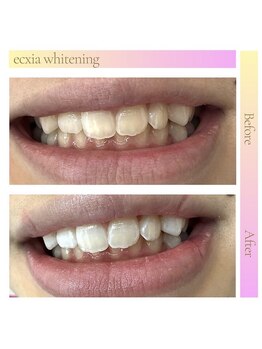 エクシアホワイトニング 天王寺店/ホワイトニングビフォーアフター