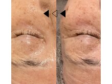 バタフライ 津田沼店(Butterfly)/Butterflyのハーブピーリング