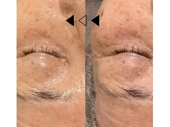 バタフライ 津田沼店(Butterfly)/Butterflyのハーブピーリング