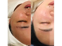 バンビマイブロウ(banbi_my_brow)の雰囲気（顔脱毛+ハリウッドブロウのセットメニューが当店1番人気です♪）