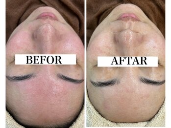 リラビューティー(Lilas Beauty)/ハーブ&ジュエリーWピーリング