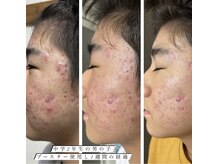 クイーン ビューティーサロン 大久保本店(Queen Beauty Salon)/話題の塗る針で肌質改善