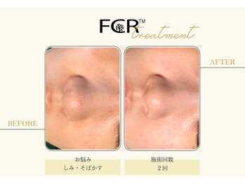 ハーバル 新宿店(HERBAL)/最強★韓国FCRハーブピーリング