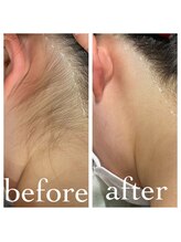 ミシェル(Michelle)/えりあし脱毛