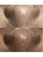 スパークル/毛穴/毛穴洗浄/黒ずみ/小顔