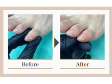 巻き爪補正店 錦糸町店/【副爪ケア】