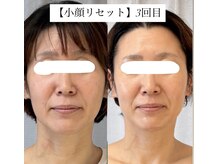 グラースア(grace a)/【小顔ケア】