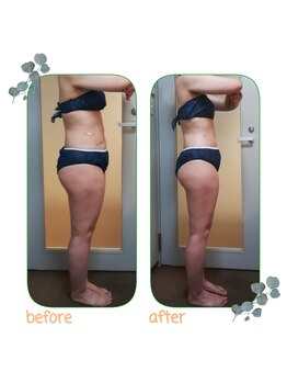 ダイエット サポート(DIET SUPPORT)/短期&グロッティ 施術結果