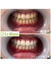 ルブラン 奈良店(Le Blanc)/【簡単施術で白い歯に！】
