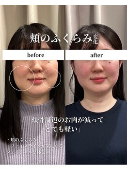 フェアリーフェイス 南森町店(Fairy Face)/【南森町/エラ】小顔矯正２回目